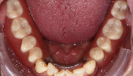 Denture Supported by Implant (Result)	